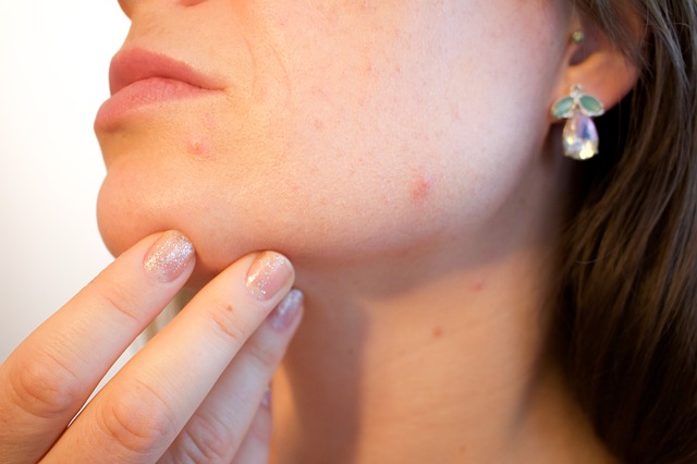 Acne1606765 640